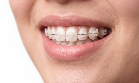 clear braces